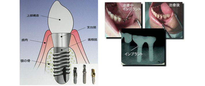インプラント治療のご案内｜歯科センターのご案内｜新八千代病院